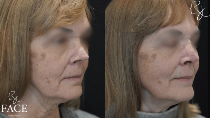 rivisionRhinoplasty3-right