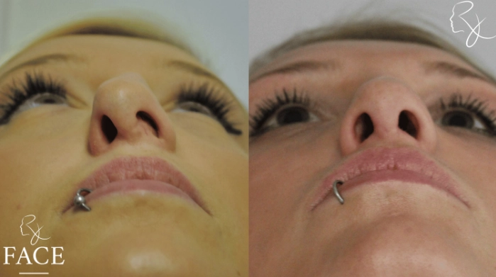 rivisionRhinoplasty4-forwardUp