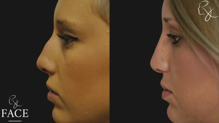 rivisionRhinoplasty4-leftProfile