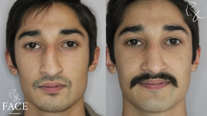 rivisionRhinoplasty5-forward