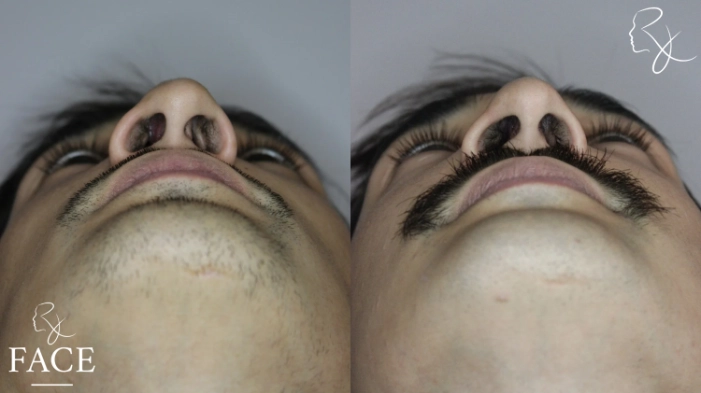 rivisionRhinoplasty5-forwardUp