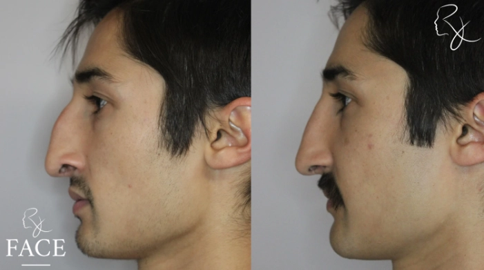 rivisionRhinoplasty5-leftProfile