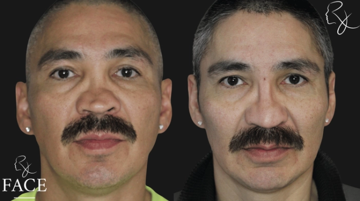 rivisionRhinoplasty6-forward