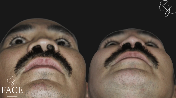 rivisionRhinoplasty6-forwardUp