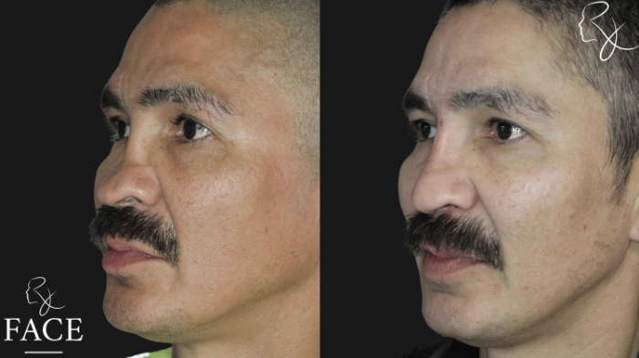 rivisionRhinoplasty6-left
