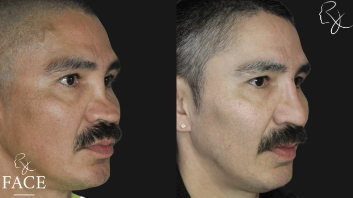 rivisionRhinoplasty6-right